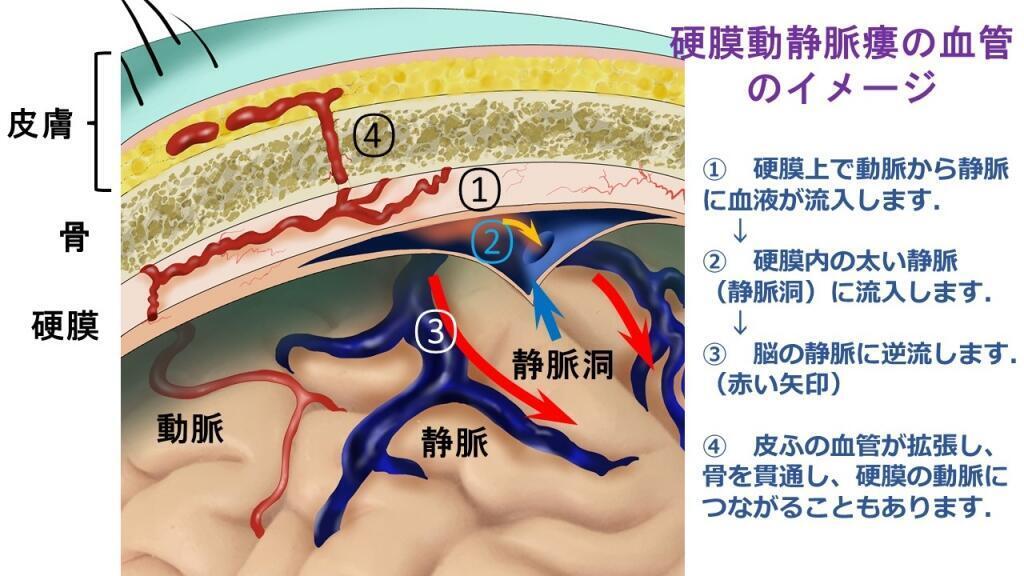 ブルック回腸瘻造設術のリスクと合併症