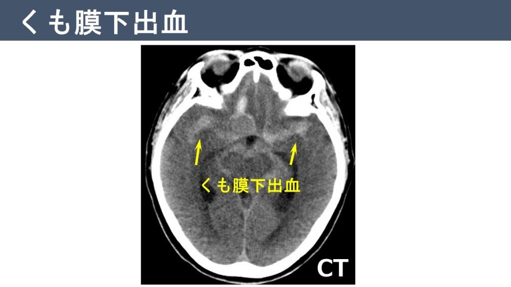 脳動脈瘤について | 国家公務員共済組合連合会 横浜栄共済病院